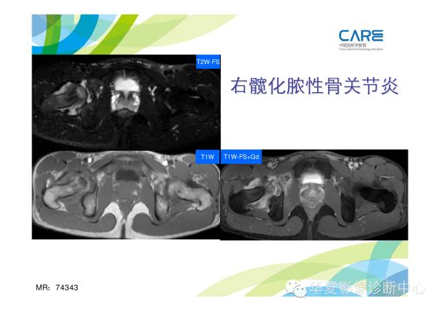 【PPT】骨肌系统影像学基本征象的再认识