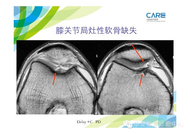 【PPT】骨肌系统影像学基本征象的再认识
