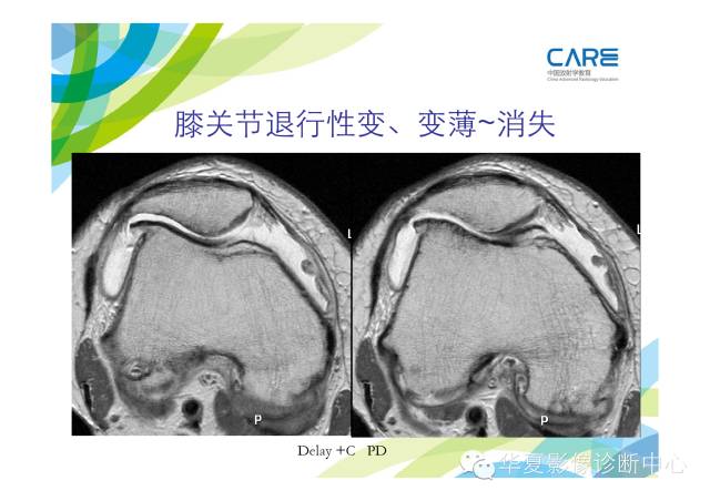 【PPT】骨肌系统影像学基本征象的再认识
