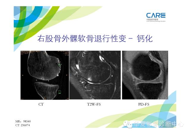 【PPT】骨肌系统影像学基本征象的再认识