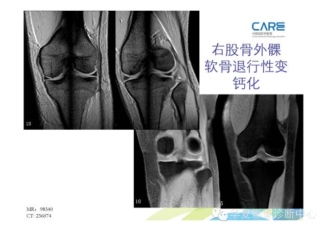 【PPT】骨肌系统影像学基本征象的再认识
