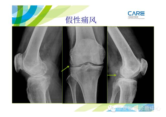【PPT】骨肌系统影像学基本征象的再认识