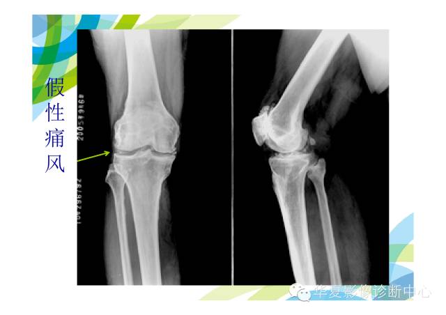 【PPT】骨肌系统影像学基本征象的再认识
