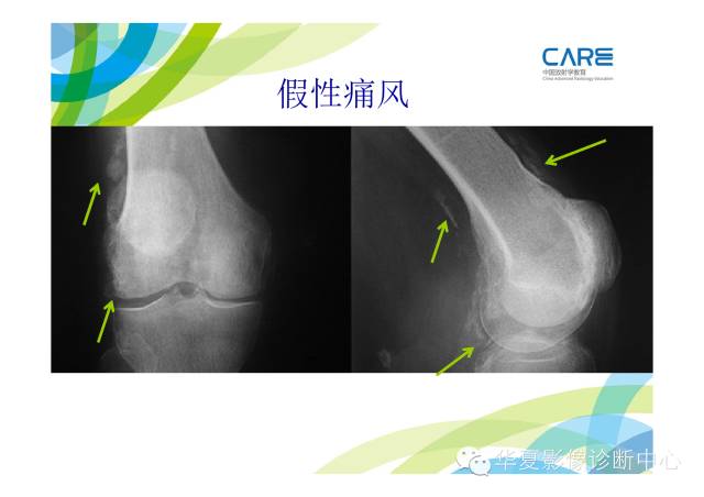 【PPT】骨肌系统影像学基本征象的再认识