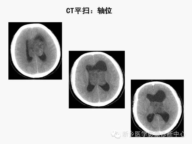 【病例】室管膜下瘤1例CT MR影像表现与鉴别