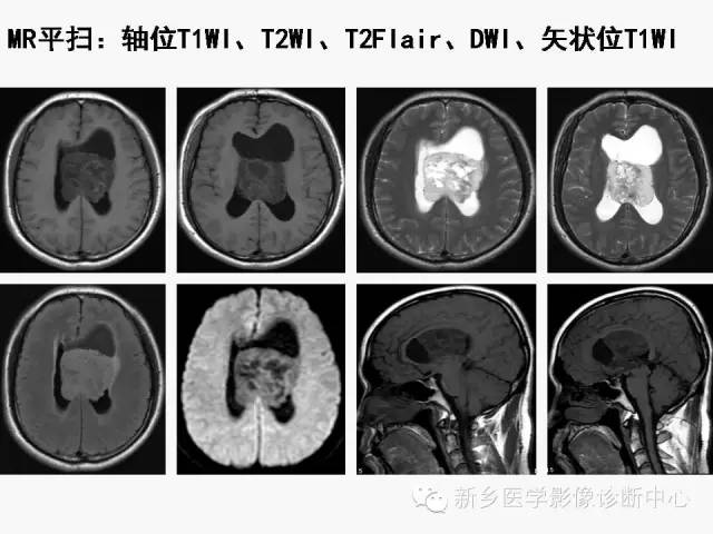【病例】室管膜下瘤1例CT MR影像表现与鉴别