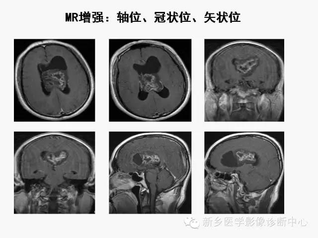 【病例】室管膜下瘤1例CT MR影像表现与鉴别