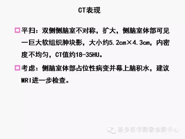 【病例】室管膜下瘤1例CT MR影像表现与鉴别