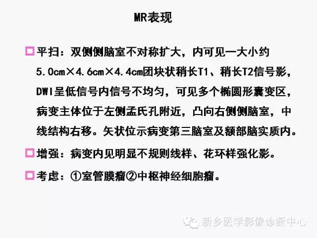 【病例】室管膜下瘤1例CT MR影像表现与鉴别
