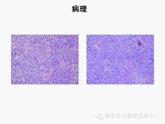 【病例】室管膜下瘤1例CT MR影像表现与鉴别