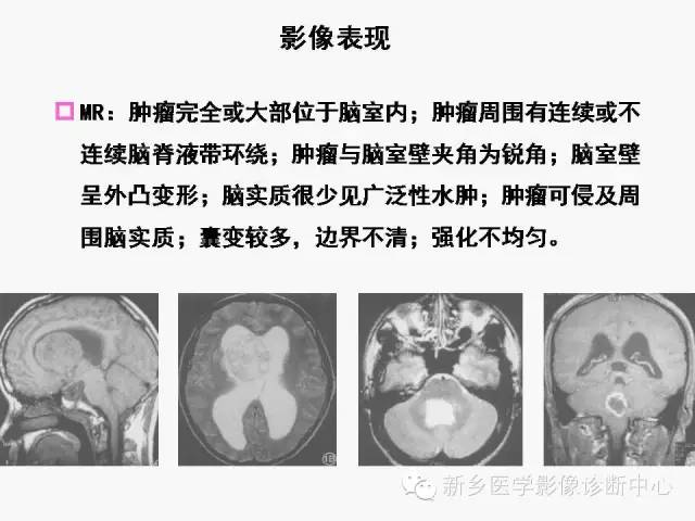 【病例】室管膜下瘤1例CT MR影像表现与鉴别