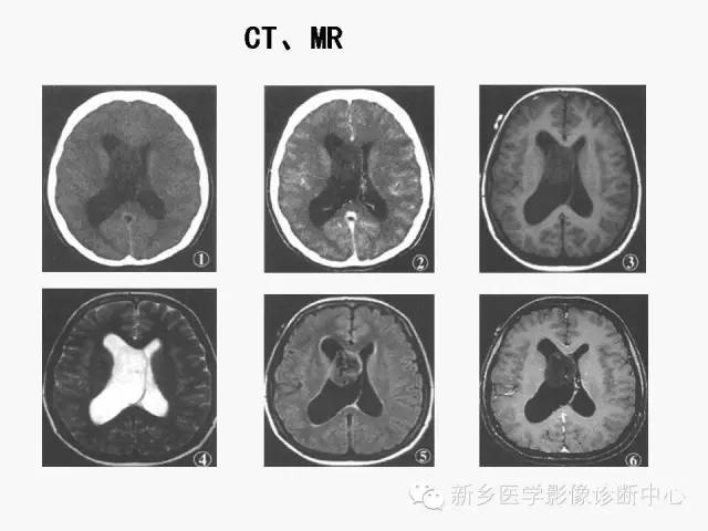 【病例】室管膜下瘤1例CT MR影像表现与鉴别