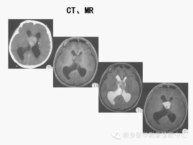【病例】室管膜下瘤1例CT MR影像表现与鉴别
