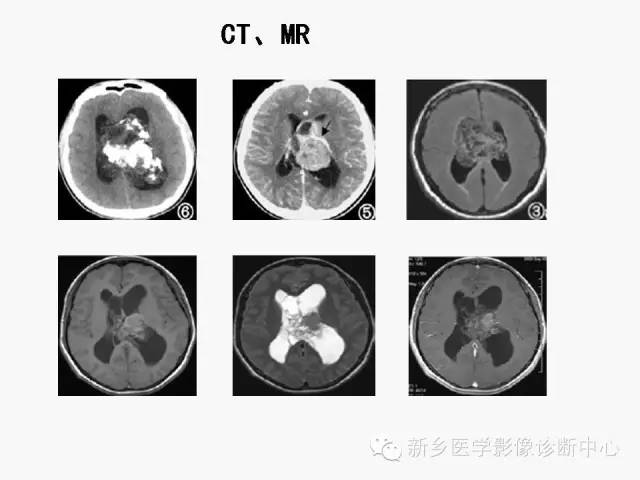 【病例】室管膜下瘤1例CT MR影像表现与鉴别