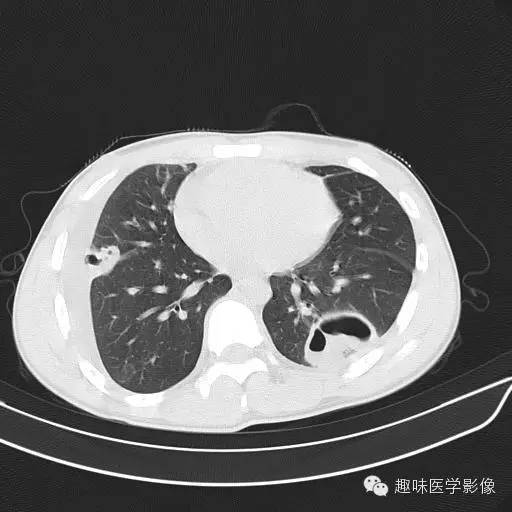 【病例】金葡菌性肺炎1例CT影像表现