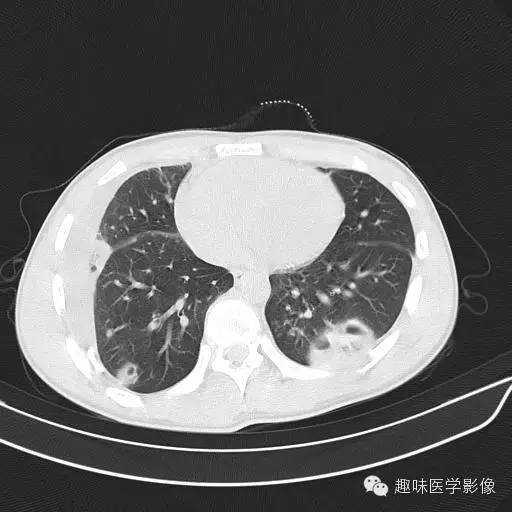 【病例】金葡菌性肺炎1例CT影像表现