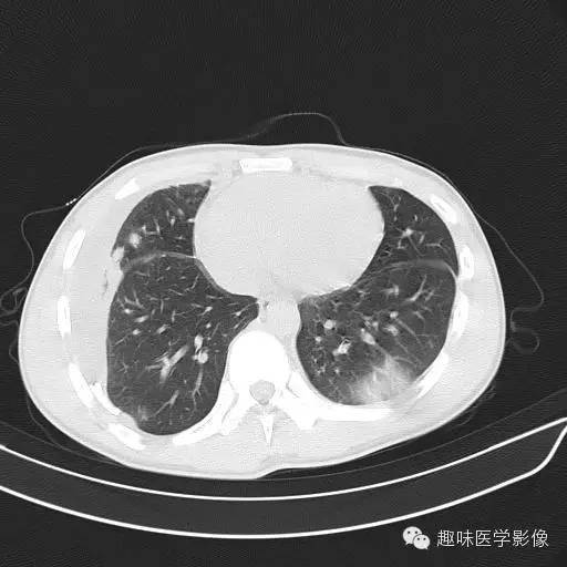 【病例】金葡菌性肺炎1例CT影像表现