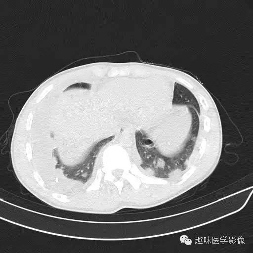 【病例】金葡菌性肺炎1例CT影像表现
