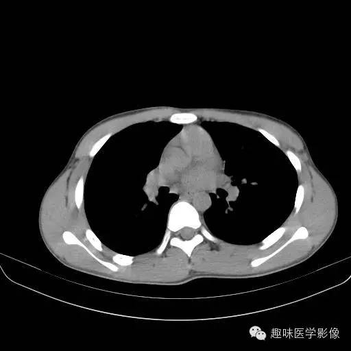 【病例】金葡菌性肺炎1例CT影像表现