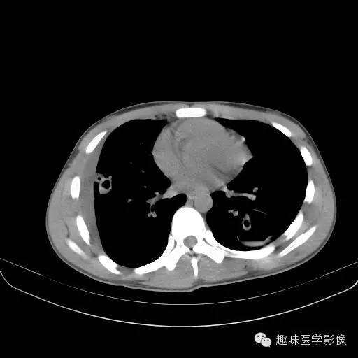 【病例】金葡菌性肺炎1例CT影像表现