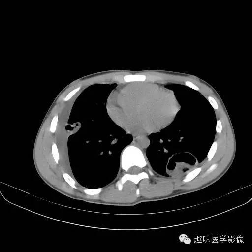 【病例】金葡菌性肺炎1例CT影像表现