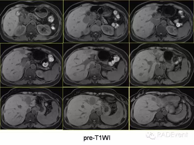 【病例】转移性胃肠道间质瘤1例MR影像表现