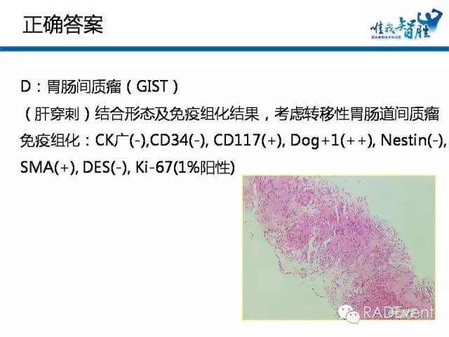 【病例】转移性胃肠道间质瘤1例MR影像表现