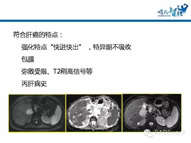 【病例】转移性胃肠道间质瘤1例MR影像表现