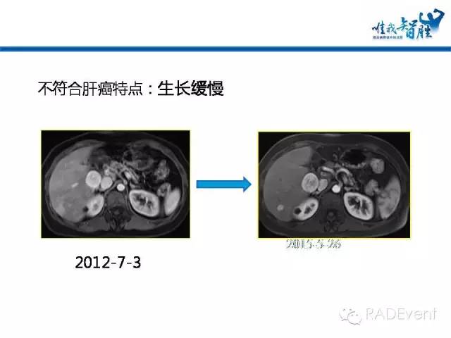 【病例】转移性胃肠道间质瘤1例MR影像表现