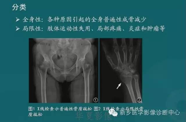 骨骼肌肉病变的基本征象——骨密度减低征象分析