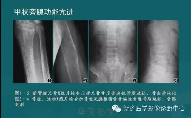 骨骼肌肉病变的基本征象——骨密度减低征象分析
