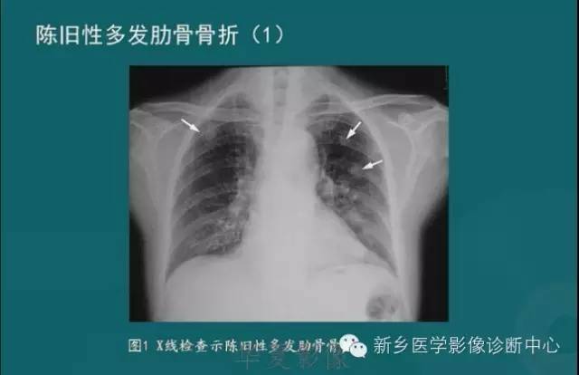 骨骼肌肉病变的基本征象——骨密度减低征象分析