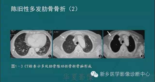 骨骼肌肉病变的基本征象——骨密度减低征象分析