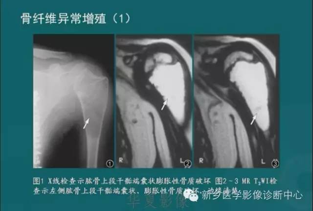 骨骼肌肉病变的基本征象——骨密度减低征象分析