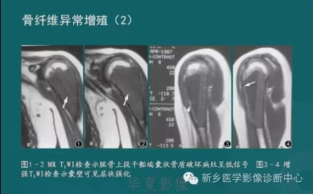 骨骼肌肉病变的基本征象——骨密度减低征象分析