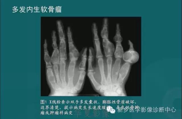 骨骼肌肉病变的基本征象——骨密度减低征象分析