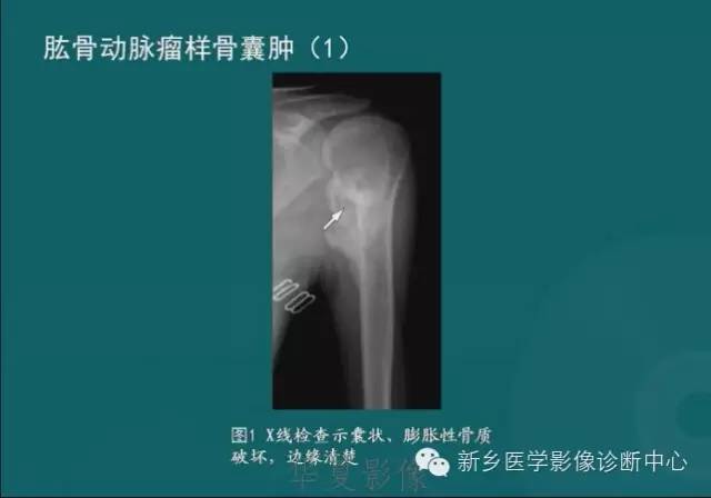 骨骼肌肉病变的基本征象——骨密度减低征象分析