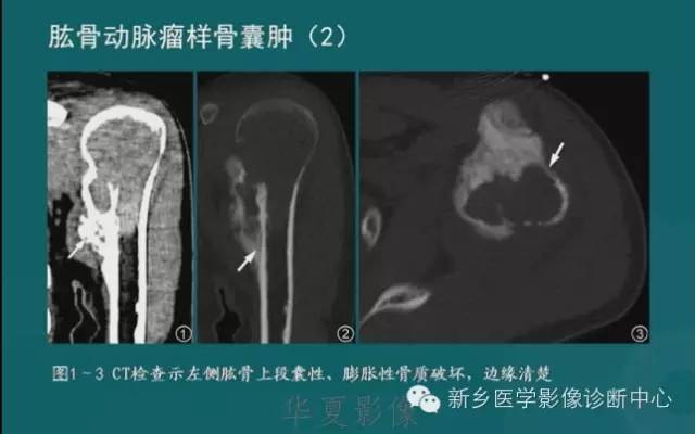 骨骼肌肉病变的基本征象——骨密度减低征象分析