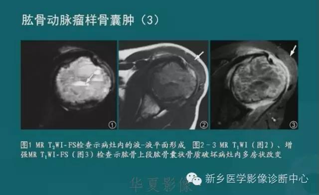 骨骼肌肉病变的基本征象——骨密度减低征象分析