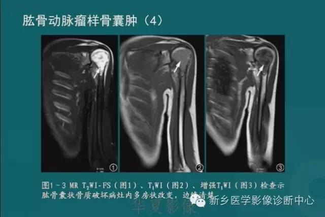骨骼肌肉病变的基本征象——骨密度减低征象分析