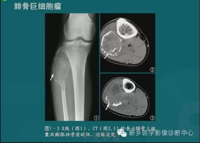骨骼肌肉病变的基本征象——骨密度减低征象分析