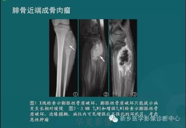 骨骼肌肉病变的基本征象——骨密度减低征象分析