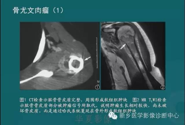 骨骼肌肉病变的基本征象——骨密度减低征象分析