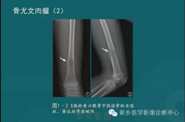 骨骼肌肉病变的基本征象——骨密度减低征象分析