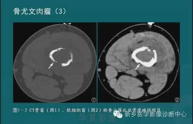骨骼肌肉病变的基本征象——骨密度减低征象分析