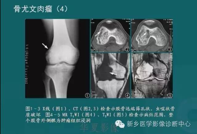 骨骼肌肉病变的基本征象——骨密度减低征象分析