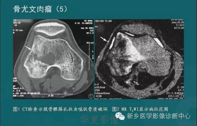 骨骼肌肉病变的基本征象——骨密度减低征象分析