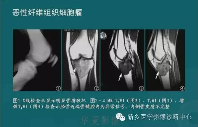 骨骼肌肉病变的基本征象——骨密度减低征象分析