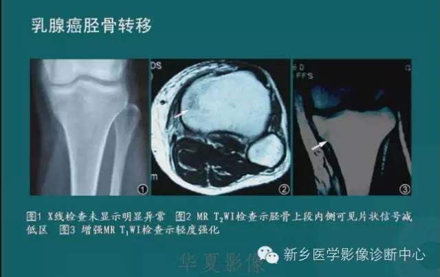 骨骼肌肉病变的基本征象——骨密度减低征象分析