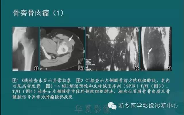 骨骼肌肉病变的基本征象——骨密度减低征象分析